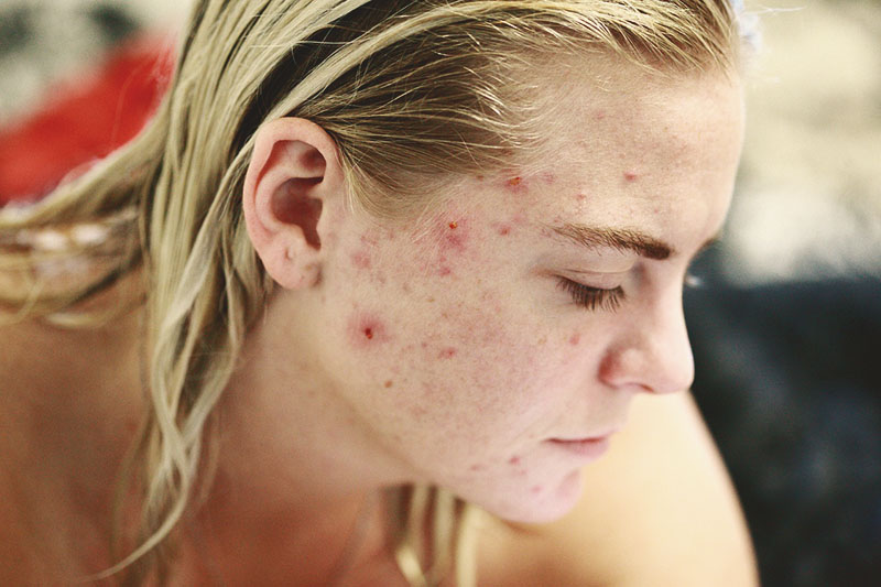 acne detox image